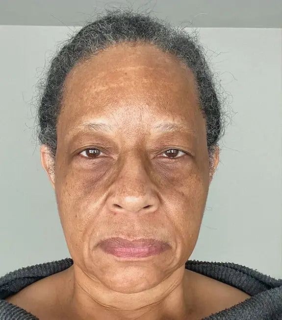 Hyperpigmentation