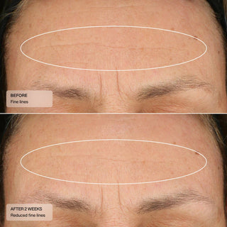 Senté Daily Repair Essential Starter Kit before and after 2 weeks - forehead showing reduced fine lines and smoother skin texture with annotated comparison circles - available at The Art of Skin Care