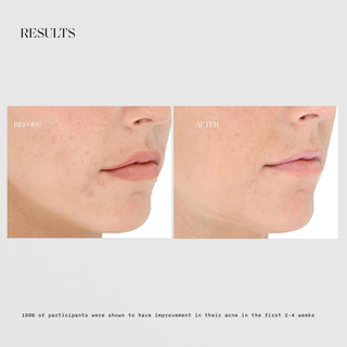 LightStim Elipsa before and after results showing visibly clearer skin and reduced acne breakouts, with 100% of participants showing improvement within 2 to 4 weeks