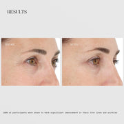 LightStim Elipsa before and after results showing visibly reduced crow's feet and fine lines around the eyes, with 100% of participants showing significant improvement