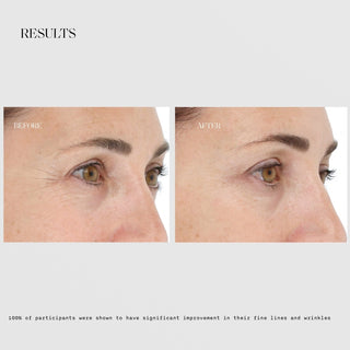 LightStim for Wrinkles before and after results showing visibly reduced crow's feet and fine lines around the eyes with 100% of participants showing significant improvement