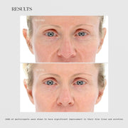 LightStim for Wrinkles before and after results showing visibly smoother forehead and reduced fine lines, with 100% of participants showing significant improvement