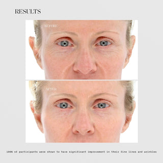 LightStim for Wrinkles before and after results showing visibly smoother forehead and reduced fine lines, with 100% of participants showing significant improvement