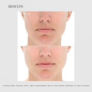 LightStim for Wrinkles before and after results showing reduced nasolabial folds and smoother skin, with 92% of participants showing further wrinkle reduction 3 months post clinical trial
