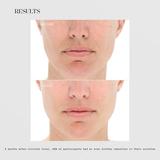 LightStim for Wrinkles before and after results showing reduced nasolabial folds and smoother skin, with 92% of participants showing further wrinkle reduction 3 months post clinical trial