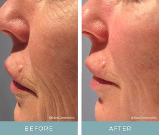 Before and after comparison of facial skin texture on a person's cheek after using NeoGenesis Recovery Serum