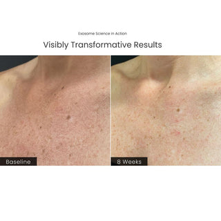 Before and after chest skin at baseline and 8 weeks using Plated Body Serum exosome science