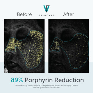 UV imaging before and after showing 89% porphyrin reduction with Regenerative Serum