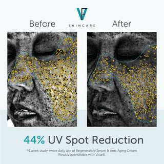 Before and after showing 44% UV spot reduction after 4 weeks using FactorFive Anti-Aging Cream