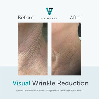 Before and after neck photos showing visual wrinkle reduction after 4 weeks