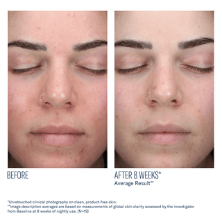 Skinbetter AlphaRet Clearing Serum - Art of Skin Care