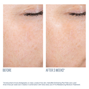 Art of Skin Care | skinbetter AlphaRet Peel Pads and Trio Rebalancing before and after smoother skin 3 weeks