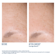 Art of Skin Care | skinbetter AlphaRet Overnight Cream before and after smoother forehead fewer fine lines 4 weeks N=48