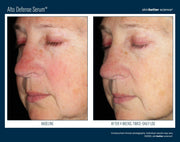 skinbetter science Alto Defense Serum before and after clinical photo showing redness and uneven skin tone at baseline on left, and visibly reduced redness and improved skin clarity after 4 weeks of twice-daily use on right. Unretouched clinical photography. Available at Art of Skin Care
