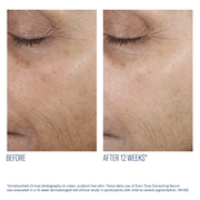 Art of Skin Care | skinbetter Even Tone Correcting Serum before and after reduced dark spots 12 weeks N=52