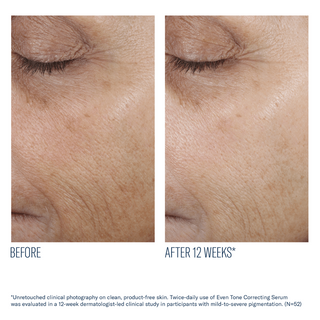 Art of Skin Care | skinbetter Even Tone Correcting Serum before and after reduced dark spots 12 weeks N=52