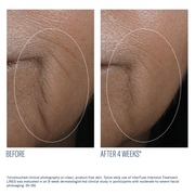 Art of Skin Care | skinbetter InterFuse LINES before and after reduced crow's feet and wrinkles 4 weeks N=25
