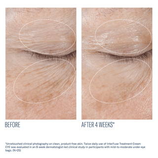 Art of Skin Care | skinbetter InterFuse Treatment Cream EYE before and after reduced under-eye bags 4 weeks N=25