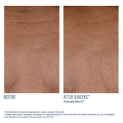 Art of Skin Care | skinbetter InterFuse FACE & NECK before and after reduced face fine lines and wrinkles 8 weeks N=52