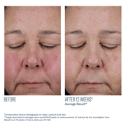 Art of Skin Care | skinbetter InterFuse FArt of Skin Care | skinbetter Mystro Active Balance Serum before and after reduced facial redness 12 weeks N=53