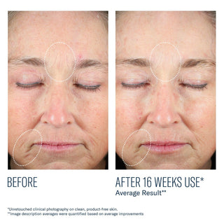 Art of Skin Care | skinbetter science before and after reduced fine lines wrinkles redness forehead eyes chin 16 weeks