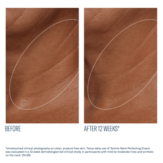 Art of Skin Care | skinbetter Techno Art of Skin Care | skinbetter Techno Neck Perfecting Cream before and after reduced neck lines crepiness 12 weeks N=26