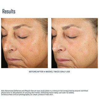skinbetter Alto Advanced Defense and Repair Serum before and after – improved lines and texture after 4 weeks clinical results