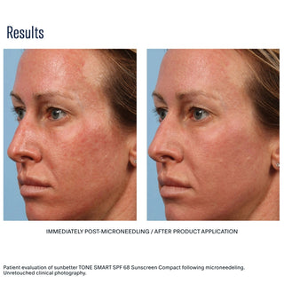 skinbetter sunbetter TONE SMART SPF 68 Sunscreen Compact – reduced redness post-microneedling clinical results side profile view