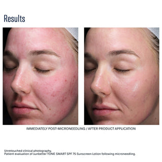 sunbetter TONE SMART SPF 75 Sunscreen Lotion before and after – reduced redness post-microneedling clinical results side profile