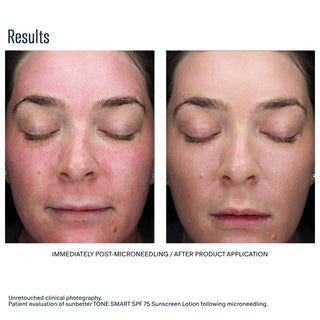 sunbetter TONE SMART SPF 75 Sunscreen Lotion – reduced redness post-microneedling clinical results front facing view